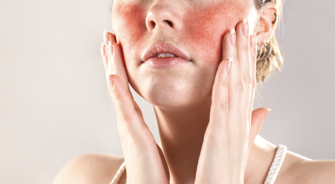Comment soigner les rougeurs du visage naturellement ?